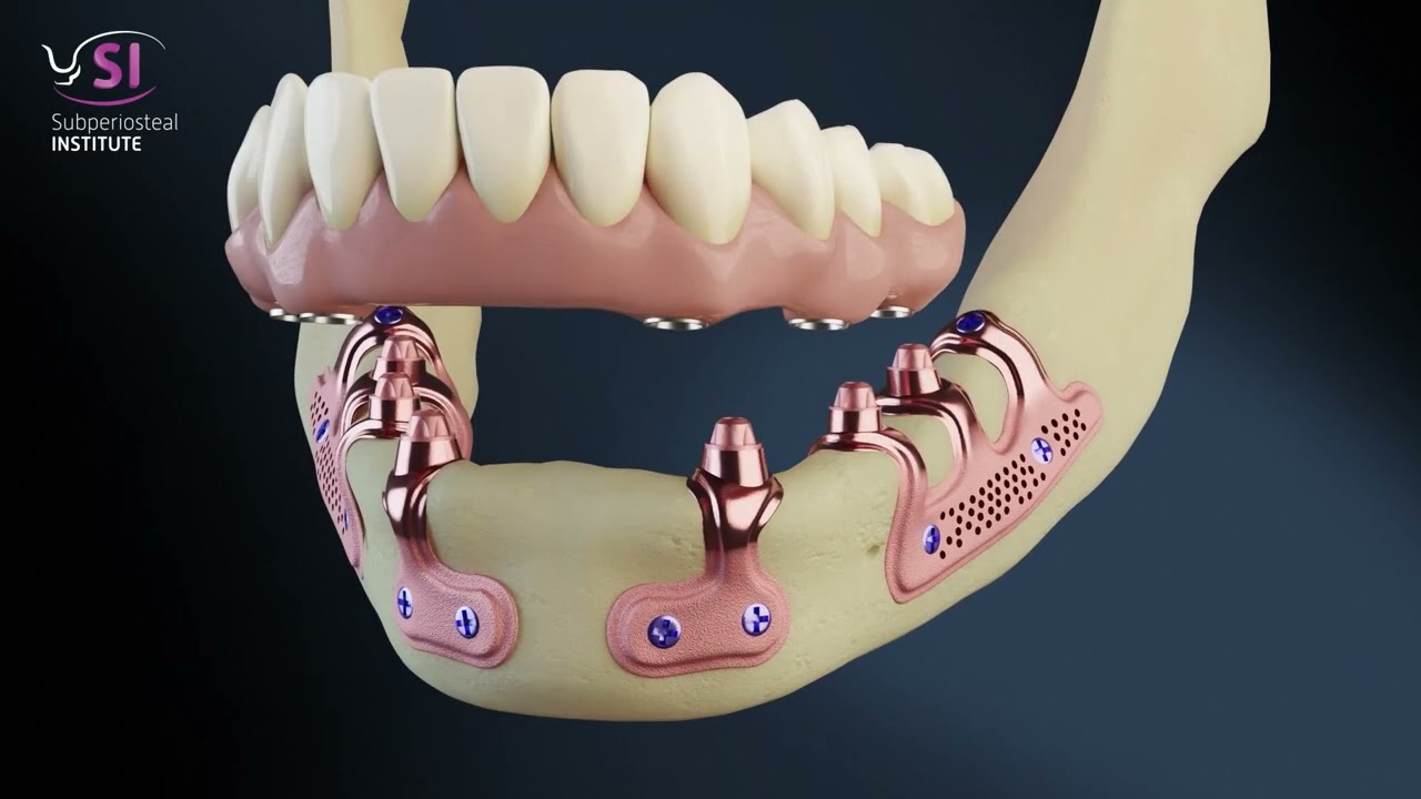 The concept of subperiosteal implants in the maxilla and mandible