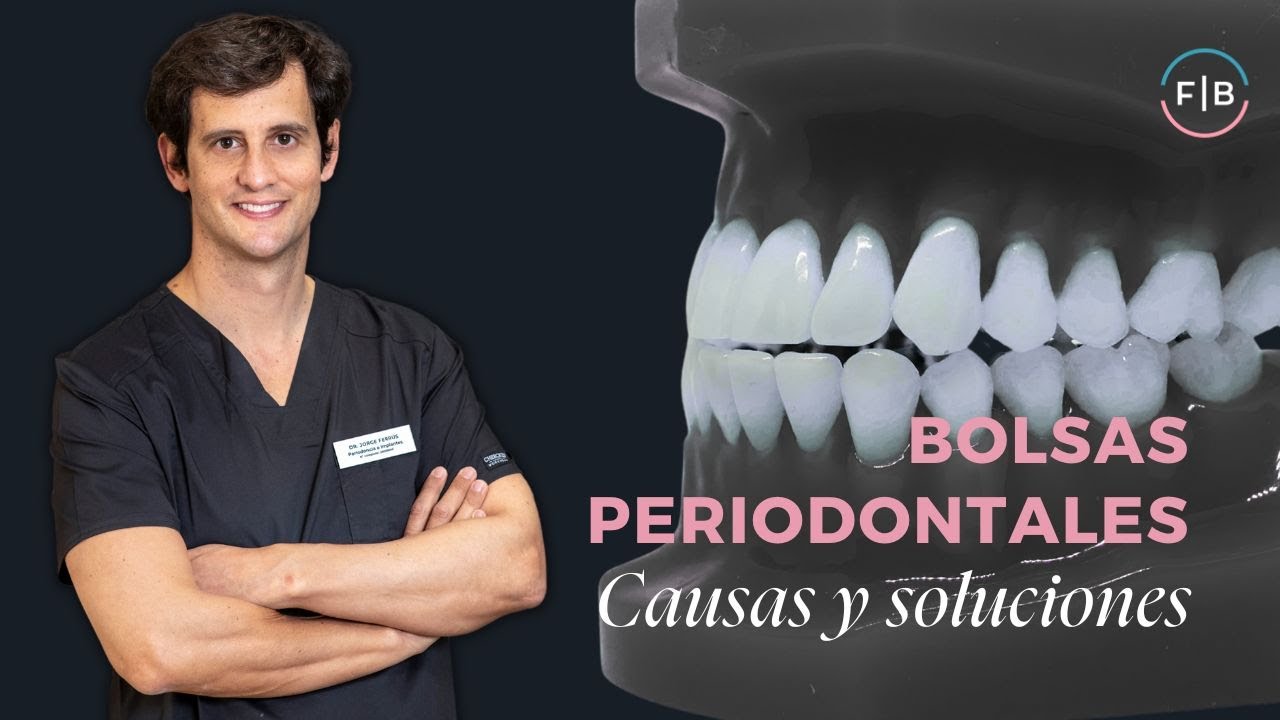 🦷 ¿BOLSAS PERIODONTALES? Soluciones a las ENCÍAS separadas