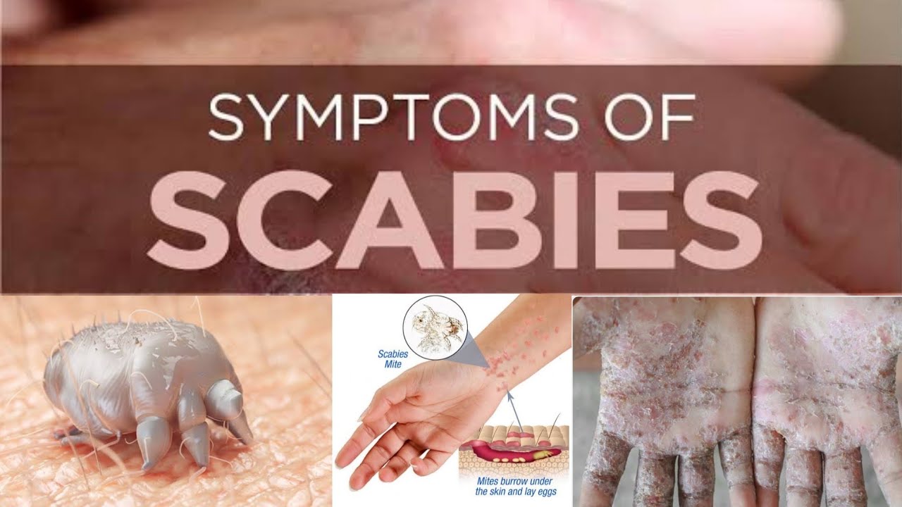 CARA MENGOBATI KUDIS ATAU SCABIES | dr. JEFFRY