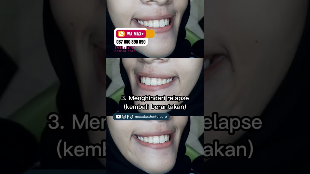 3 Alasan WAJIB Pakai Retainer Setelah Lepas Behel