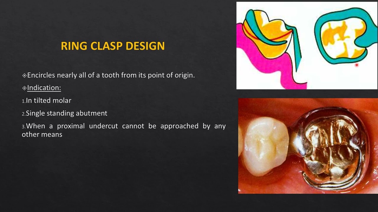 DIRECT RETAINERS & INDIRECT RETAINERS