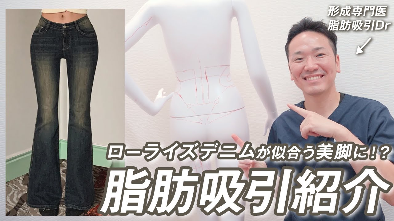 【骨格ウェーブ】ウェーブさんあるある…😢ローライズデニムで短足に見える原因を解説！脚長になれるおすすめの脂肪吸引も紹介します！【モッズクリニック】