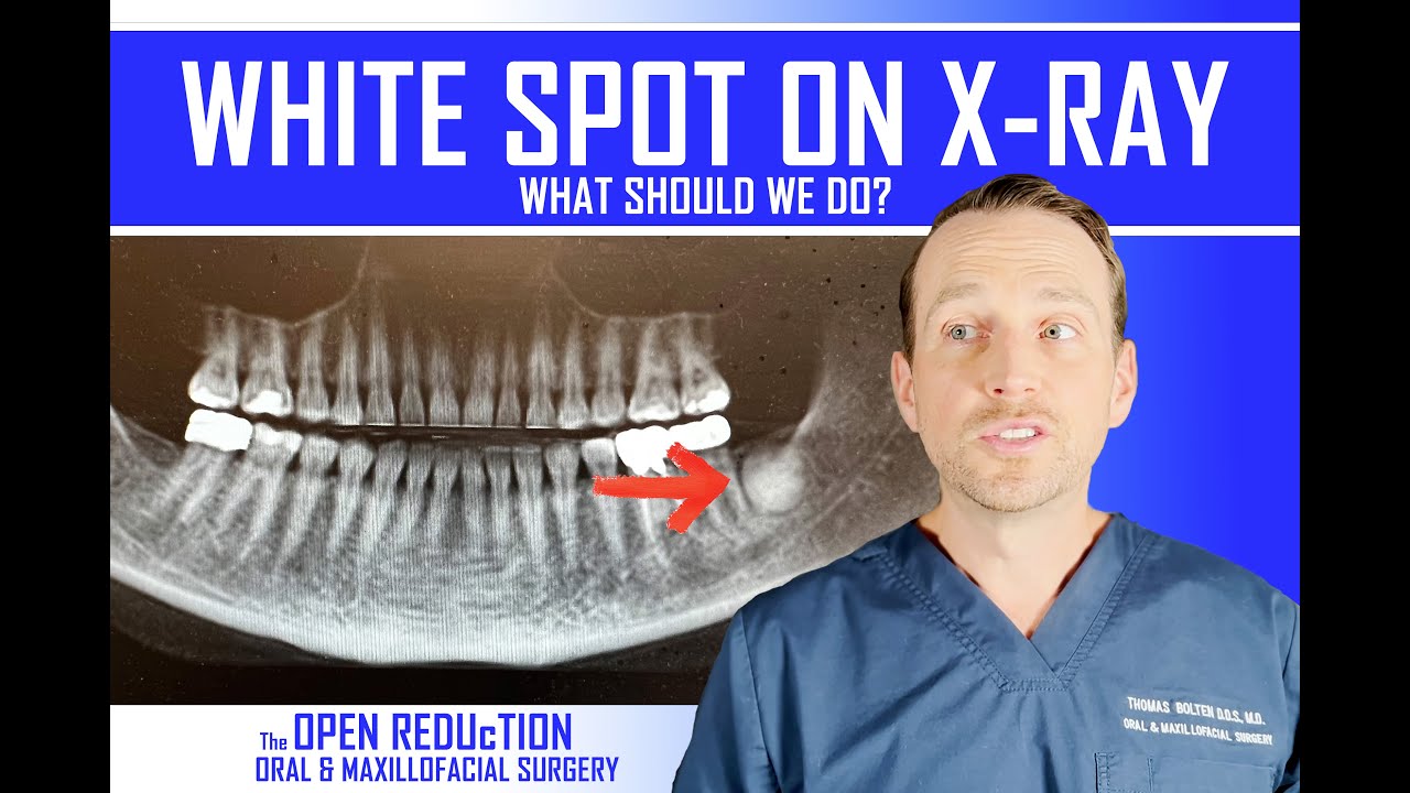 What is the WHITE SPOT on this X-RAY?? How to Evaluate a RADIOPAQUE Lesion | OMFS | Oral Path