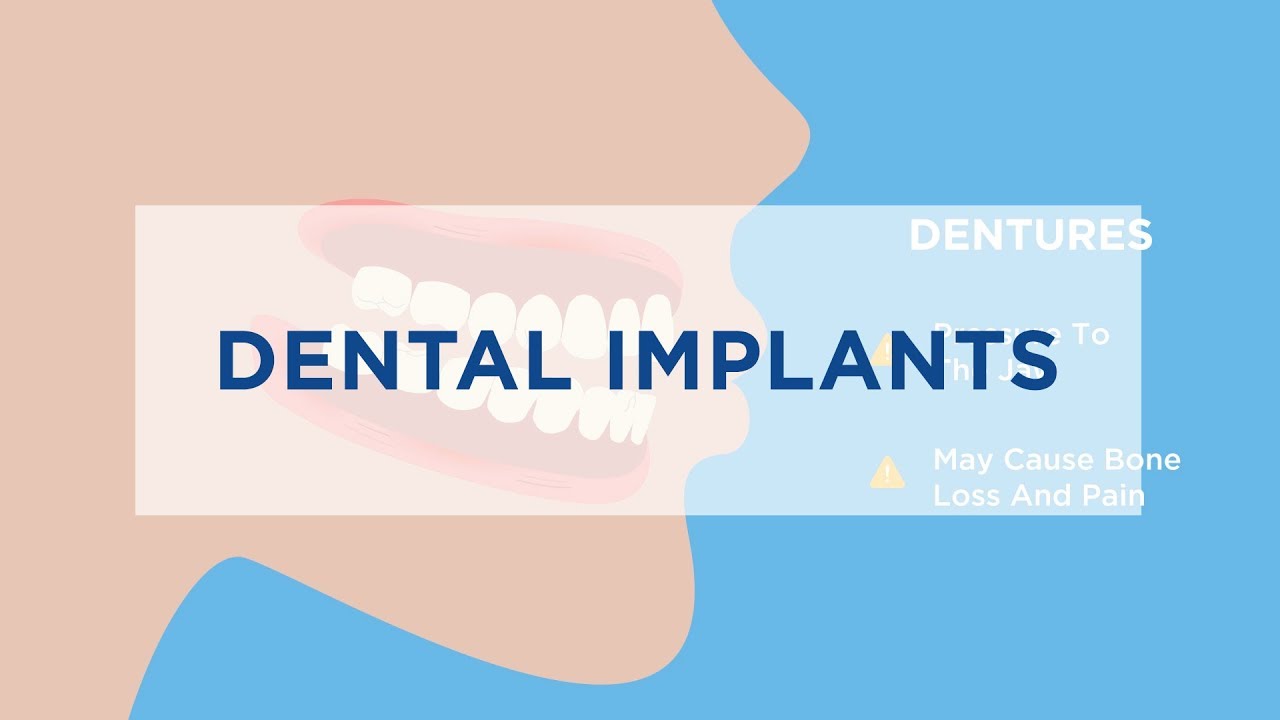 Dental Implants vs. Bridges (:15)