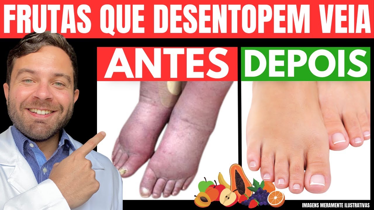 10 FRUTAS INCRÍVEIS para COMBATER MÁ CIRCULAÇÃO, VARIZES e DOR nas PERNAS