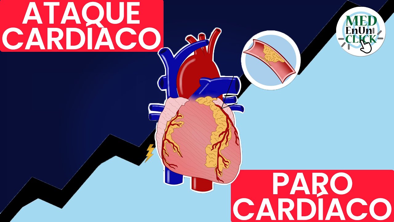 ATAQUE Card&iacute;aco VS PARO Card&iacute;aco