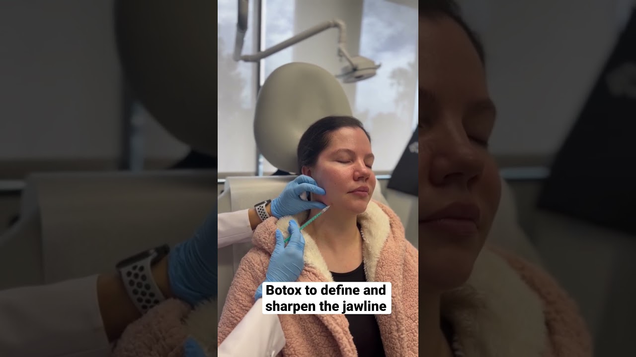 Nefertiti lift with Botox #botox #defined #jawline