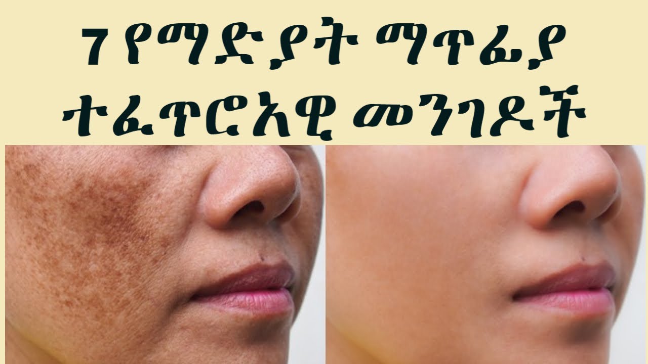 ፊታችንን ከማዲያት ነጻ ለማድረግ የሚጠቅሙ 7 ተፈጥሮአዊ መንገዶችI  7 natural way  to eliminate madiyat