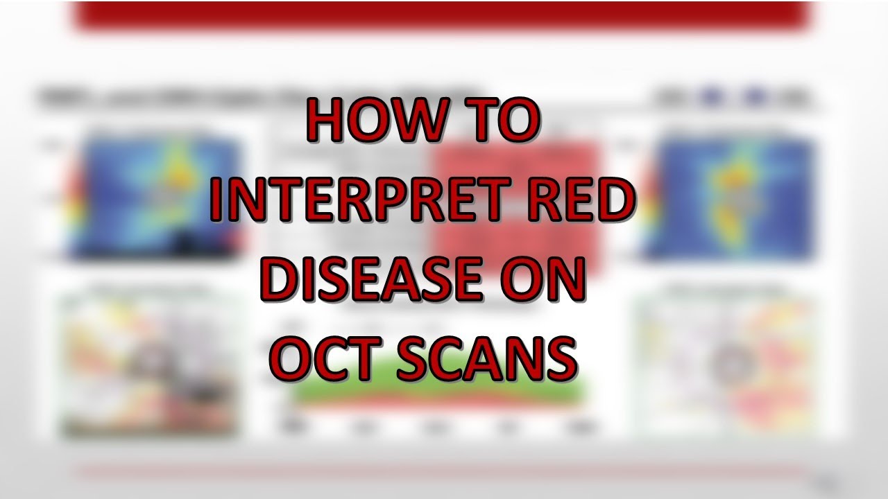 How to interpret OCT scans and red disease // #OCT #analyzingscans #isitglaucoma