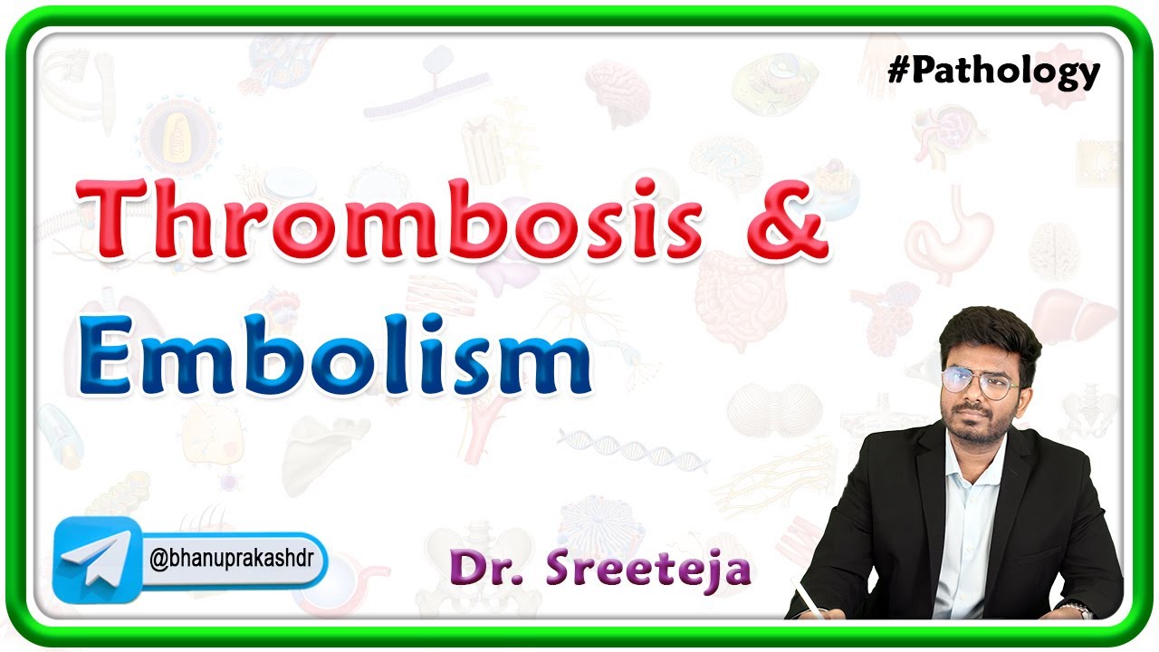 13. Thrombosis And Embolism | USMLE Step 1 Pathology