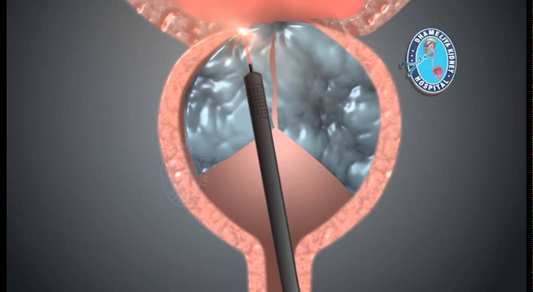 Holmium Laser Enucleation of the Prostate (HOLEP)