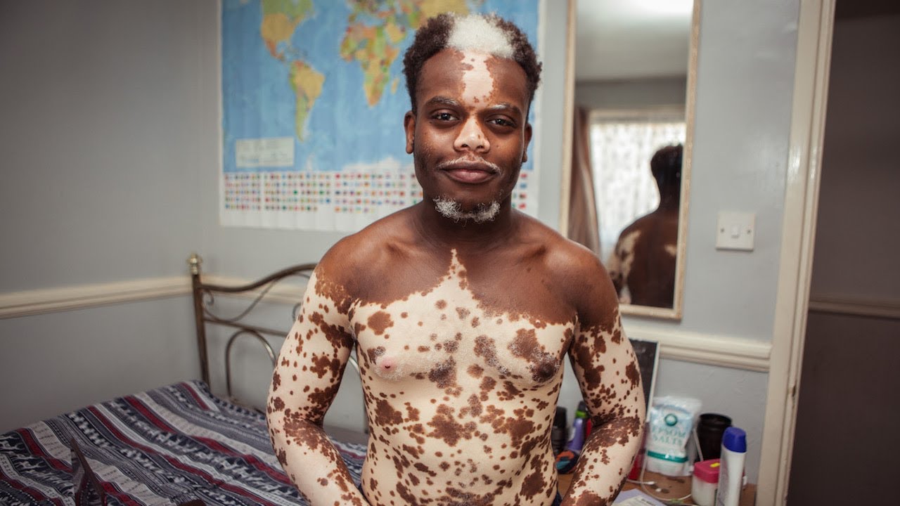 My Vitiligo is Disappearing - But I Don’t Want It To | BORN DIFFERENT