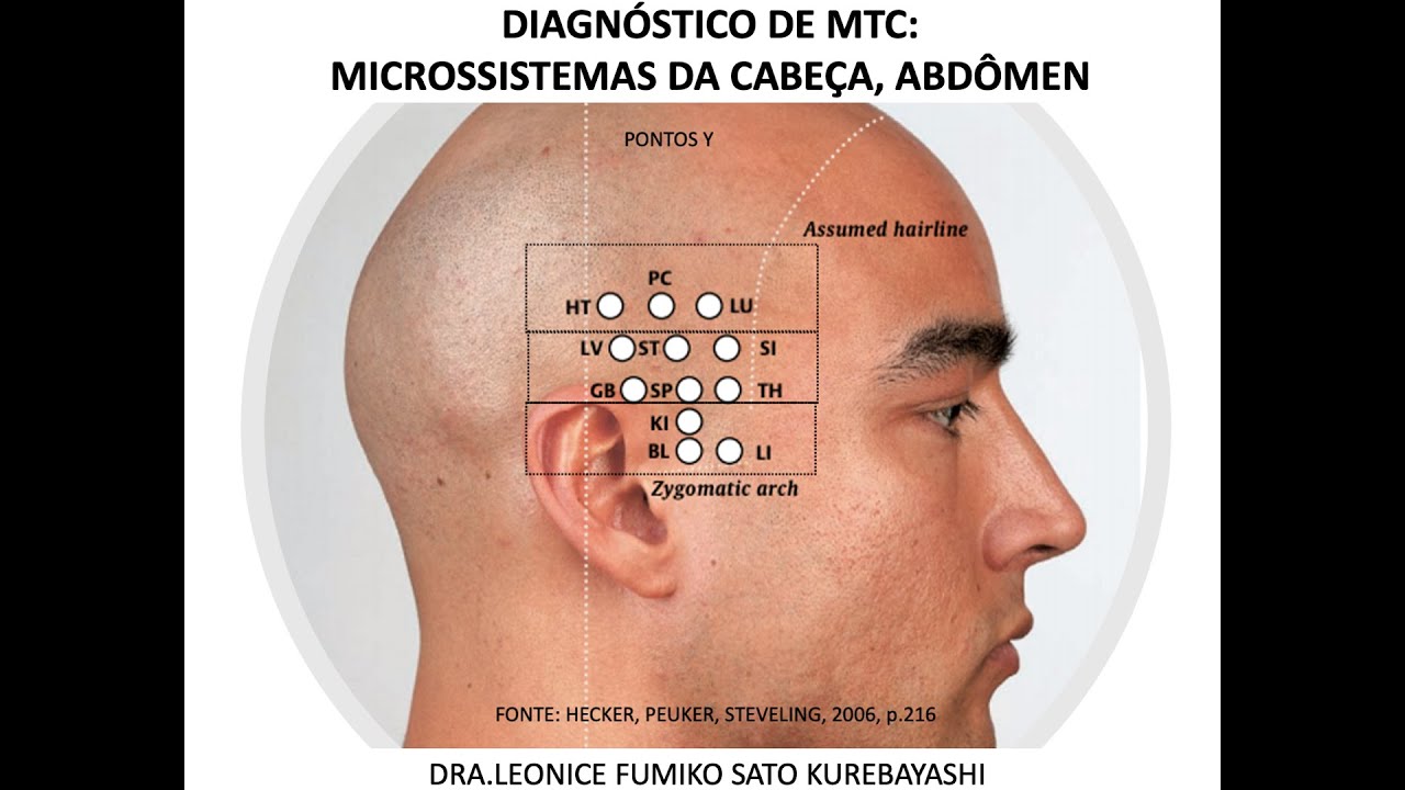 Microssistema: acupuntura escalpeana de Yamamoto