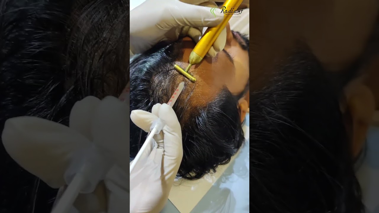 Best PRP Therapy Treatment in Jaipur #drvishalchugh #skincare #dermatologist #skindoctor