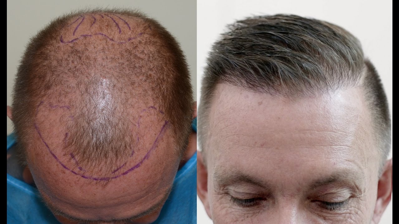 Hair transplant results after 1 year