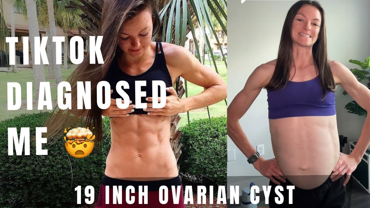 TikTok Diagnosed Me (19 inch Ovarian Cyst)￼