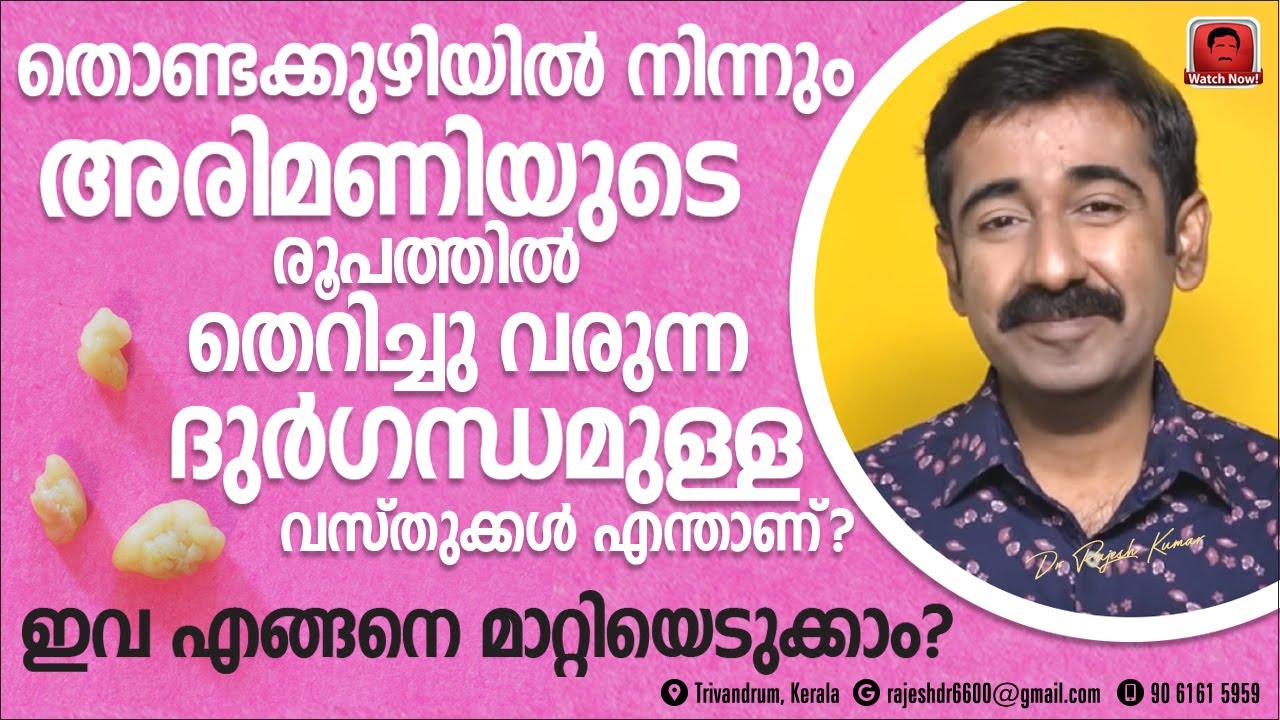 തൊണ്ടയിൽ നിന്നും ദുർഗന്ധമുള്ള അരിമണികൾ ഇടയ്ക്ക് ചാടിവരുന്നത് എങ്ങനെ ? Tonsil Stones നിയന്ത്രിക്കാം ?