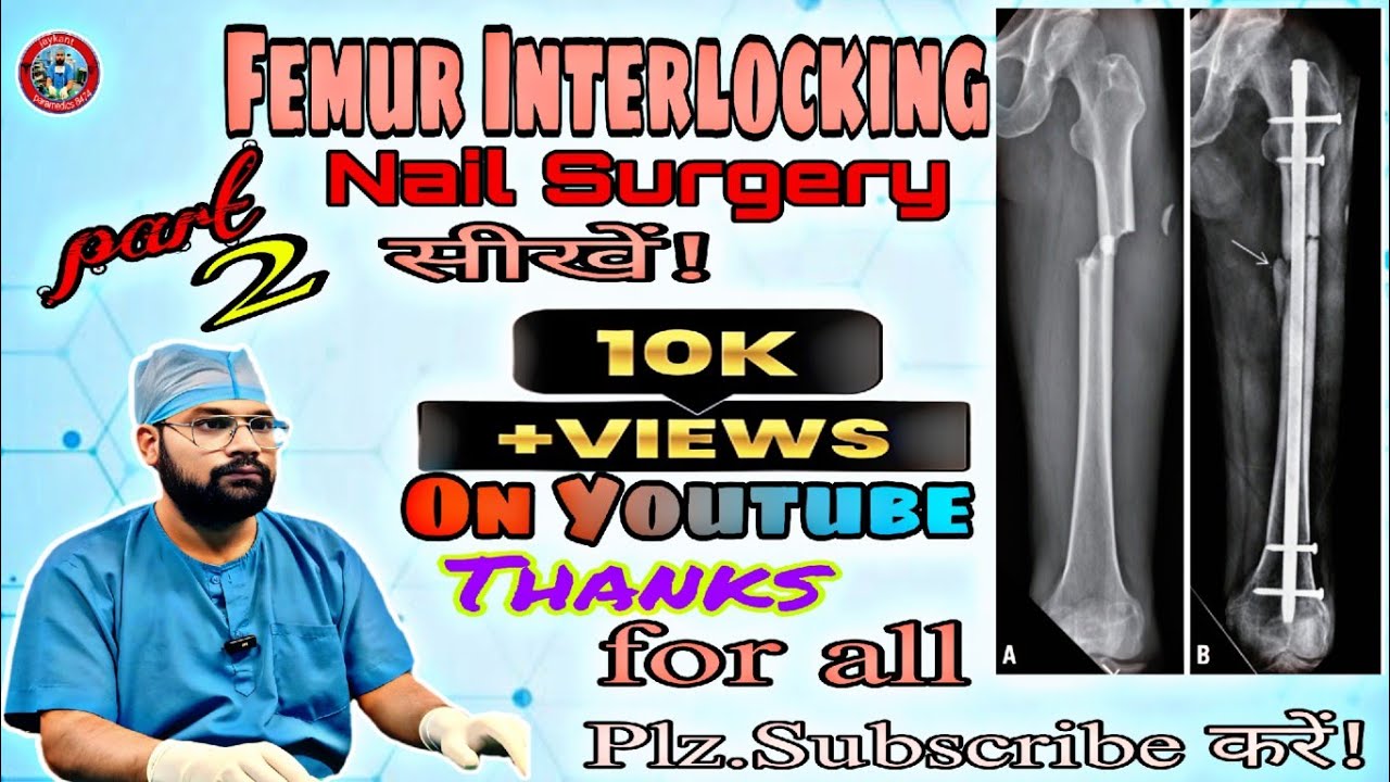 Femur interlocking nail/IMIL NAIL/ femur nail #shortvideo#ytstudioes#viral #medicalstudent 