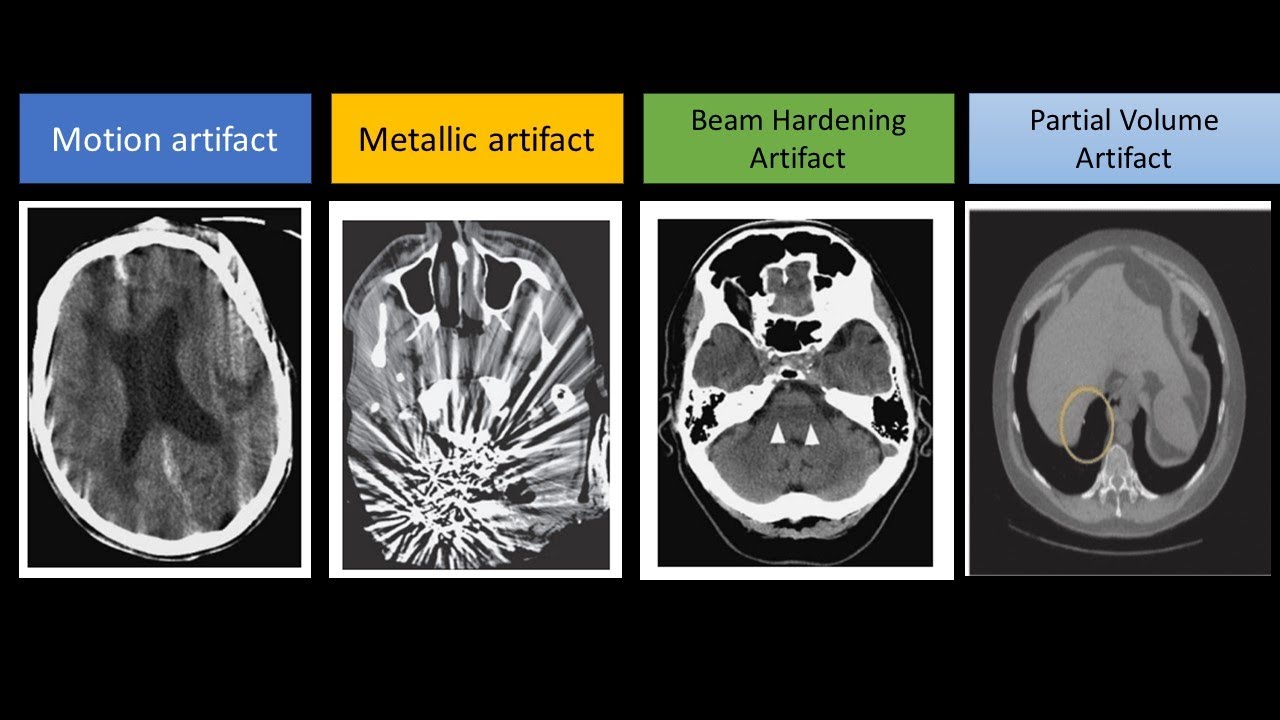 Artifacts in CT scan
