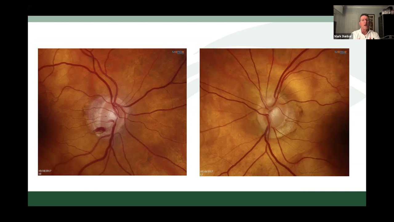 The Pressure is On:  Managing Challenging Cases in Glaucoma (11/9/2021)