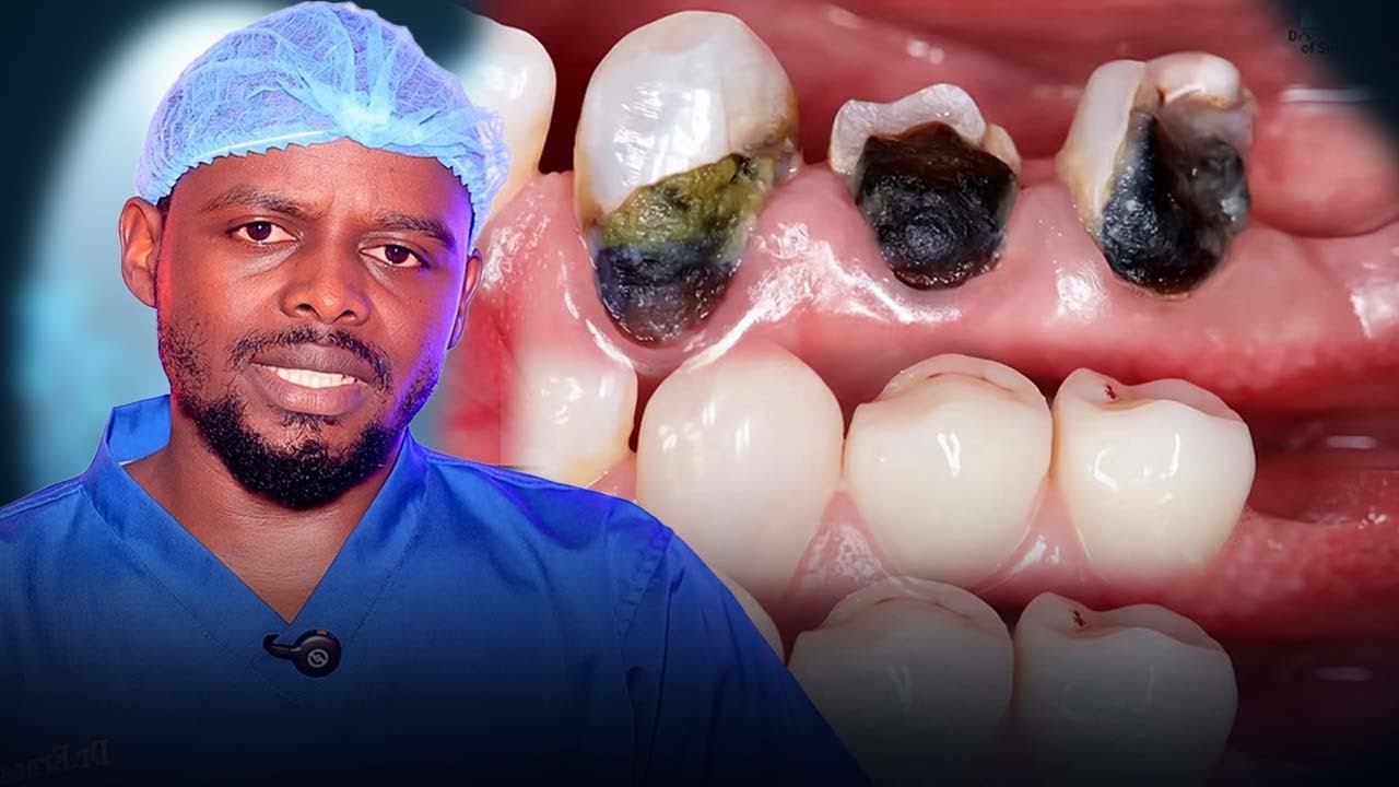 GUCUKUKA AMENYO /DENTAL CARIES or TOOTH CAVITY /DECAY | DR.ERNEST