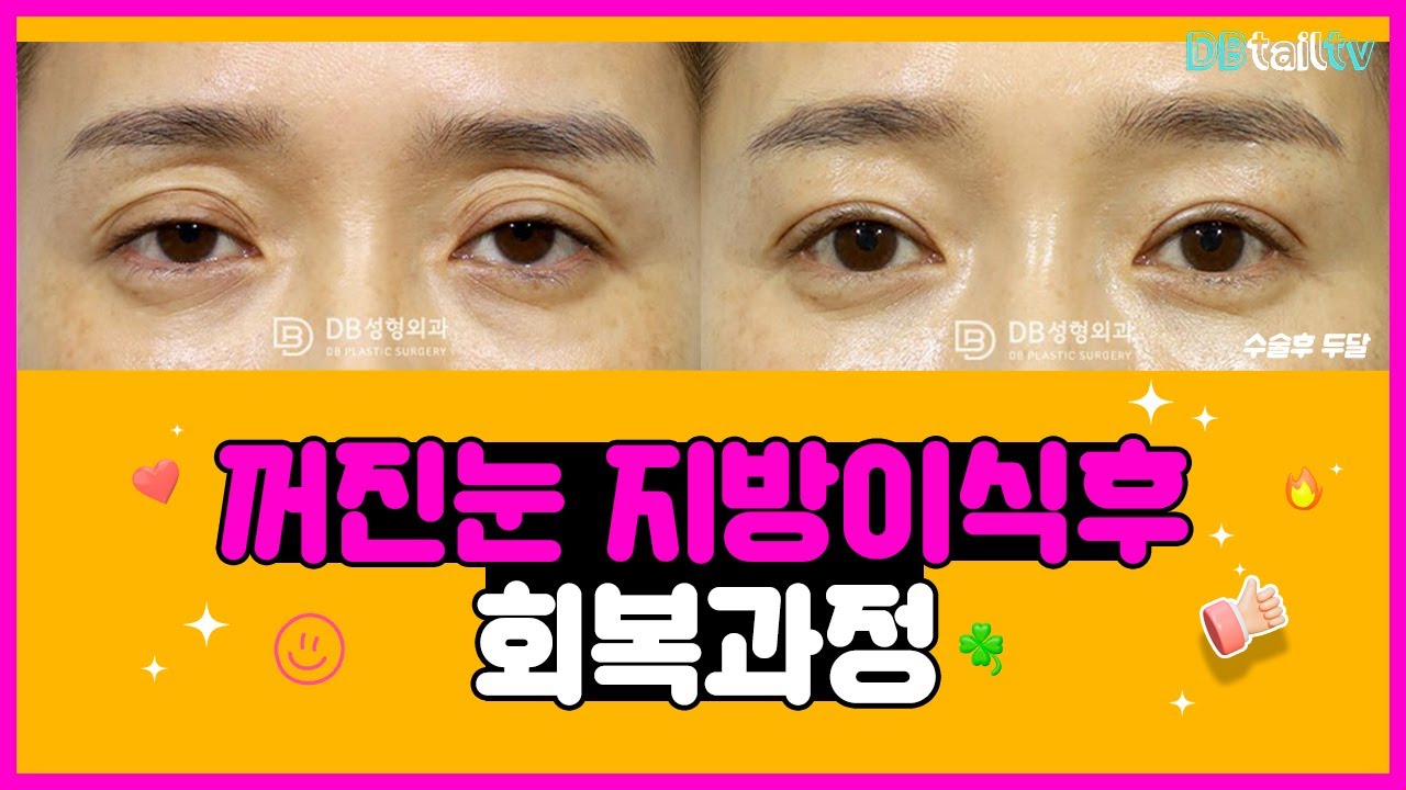 꺼진눈 지방이식후 회복과정