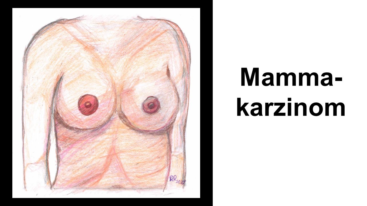 Allgemeines und Epidemiologie beim Mammakarzinom | Strahlentherapie Prof. Hilke Vorwerk