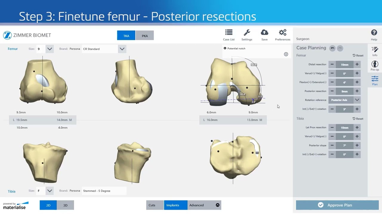 Tutorial How to Personalize Knee Alignment with 3D Planning and Guides