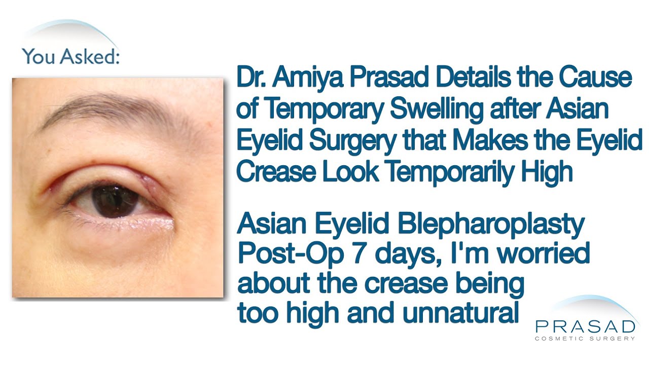 Why Temporary Swelling Concentrates in the Upper Eyelids after Asian Double Eyelid Surgery