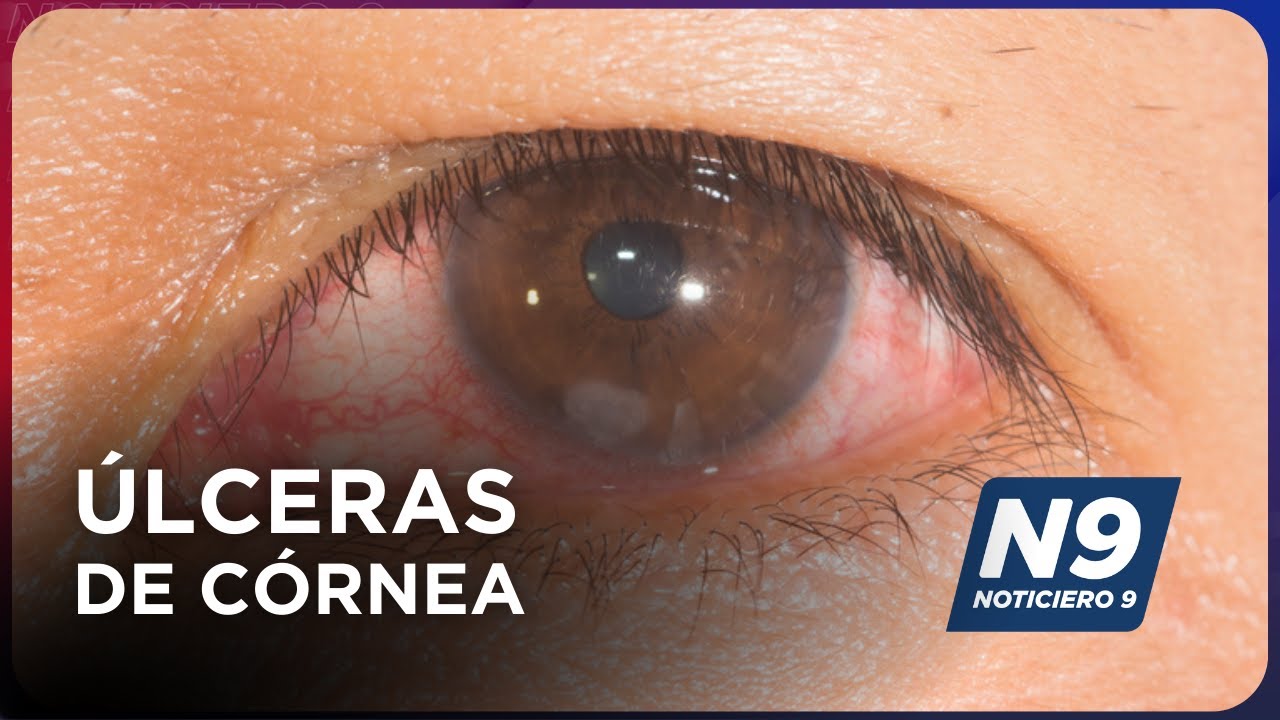 ÚLCERAS DE CÓRNEA - NOTICIERO 9