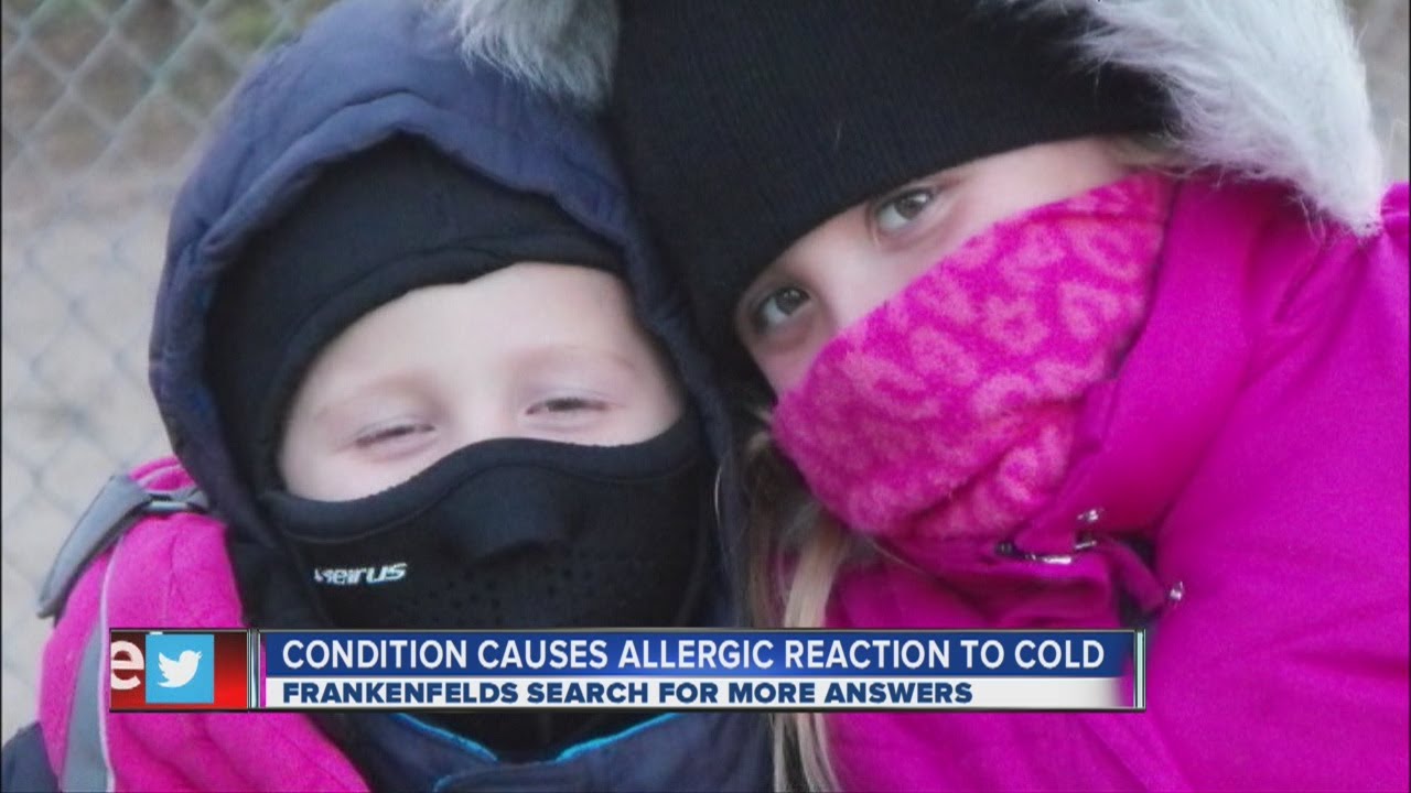 Rare condition causes allergic reaction to cold temperatures