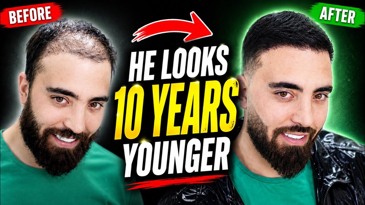 How Barber Transformed Thin & Balding Hair with Hair Fibers