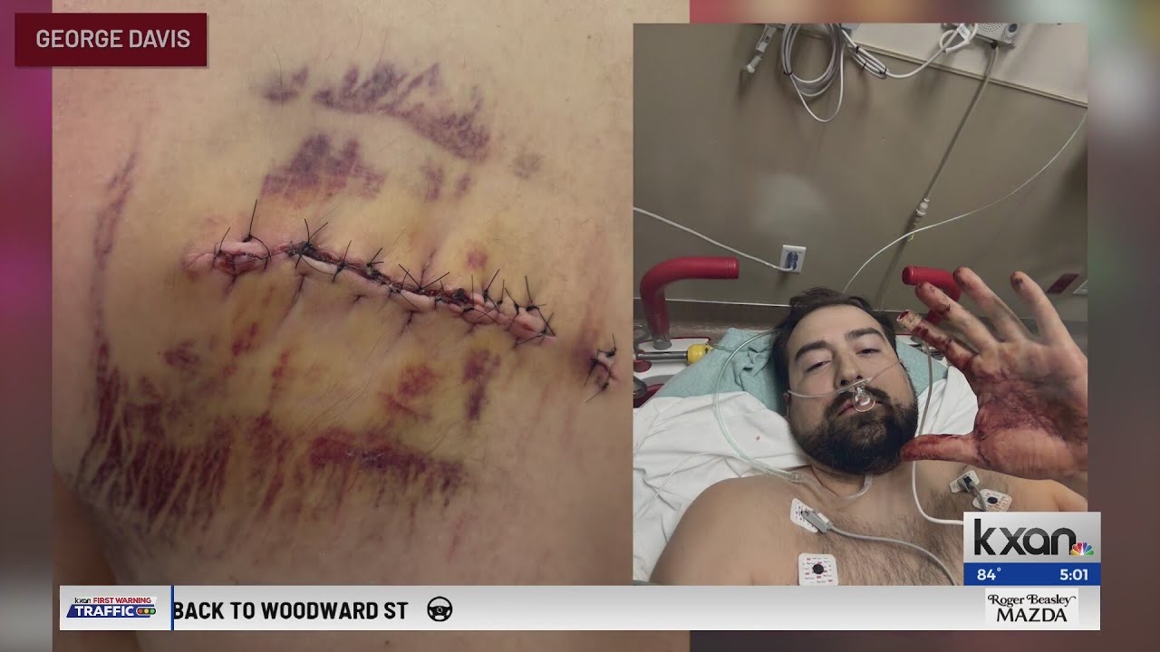 Austin mass shooting victim reflects on survival