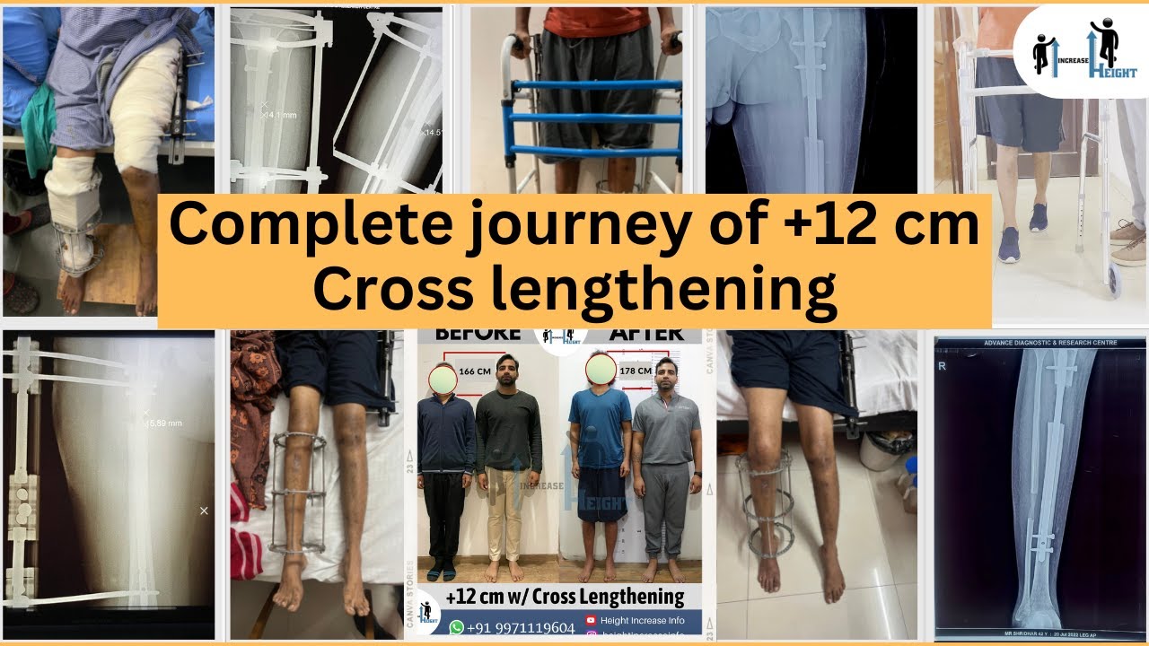 Complete journy of +12 cm #Cross #lengthening #heightincreaseinfo #height
