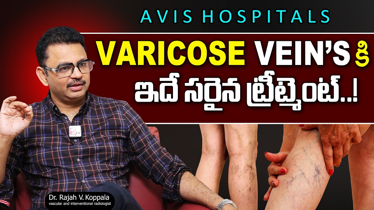 VARICOSE VEIN'S Myth's & Facts: Dr Rajah V Koppala Interesting Fact's About Varicose Veins | SumanTv