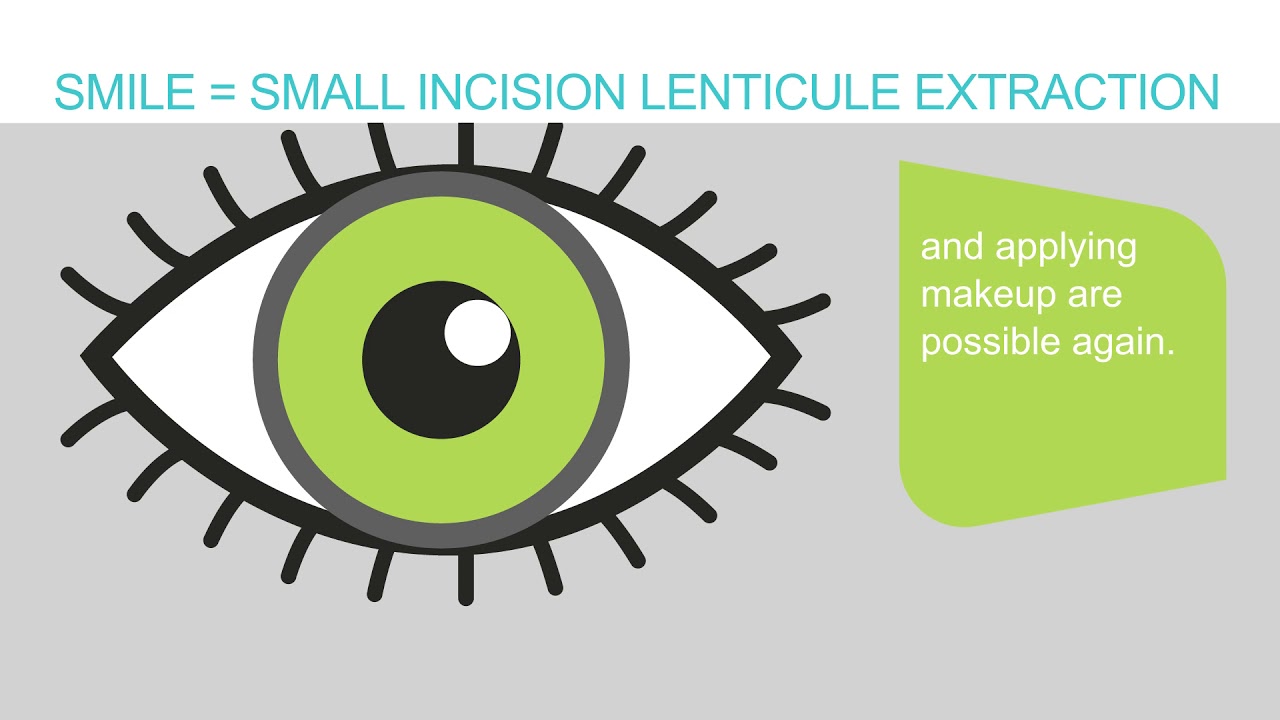 SMILE eye surgery explanation