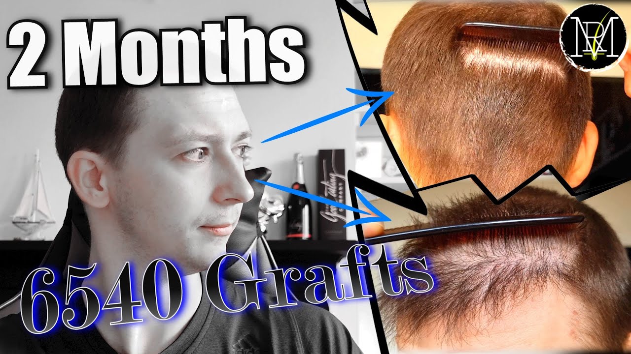 2 Months after 2nd FUE/DHI. 6500 Grafts, NW5a