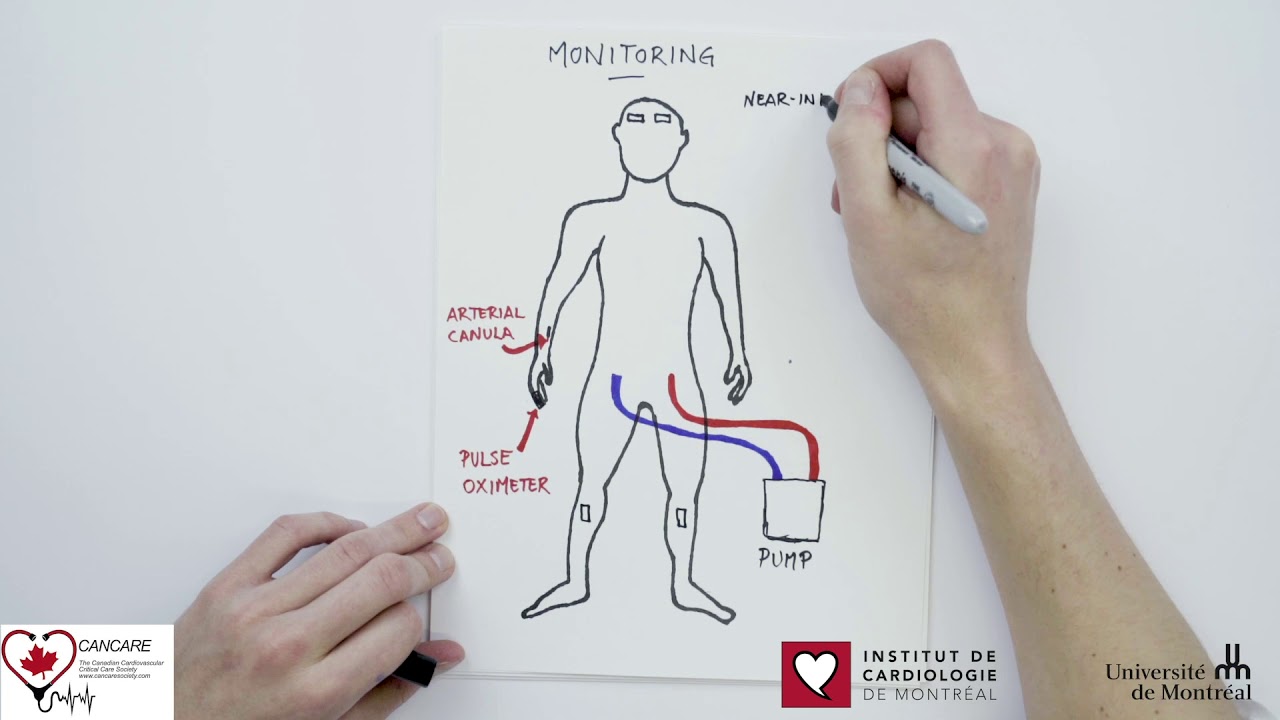 Differential Hypoxemia Veno-Arterial ECMO
