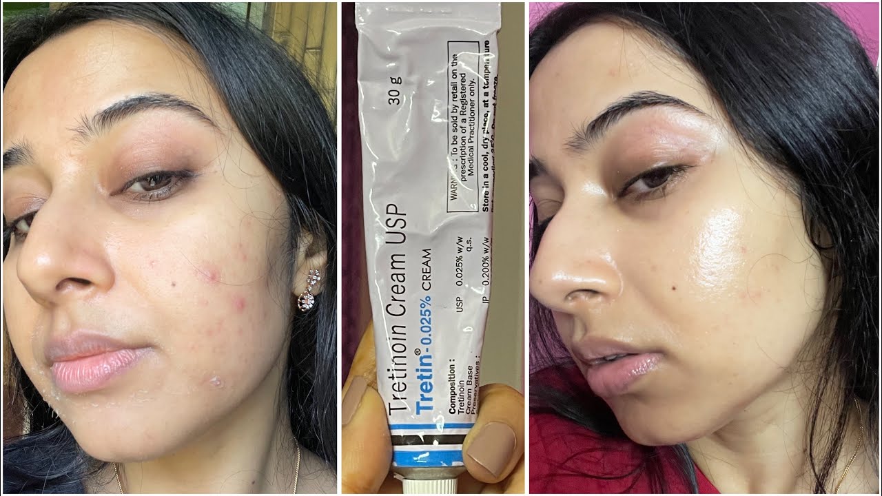 Simple Tretinoin Night Skincare Routine for Acne free Skin #skincare #tretinoin