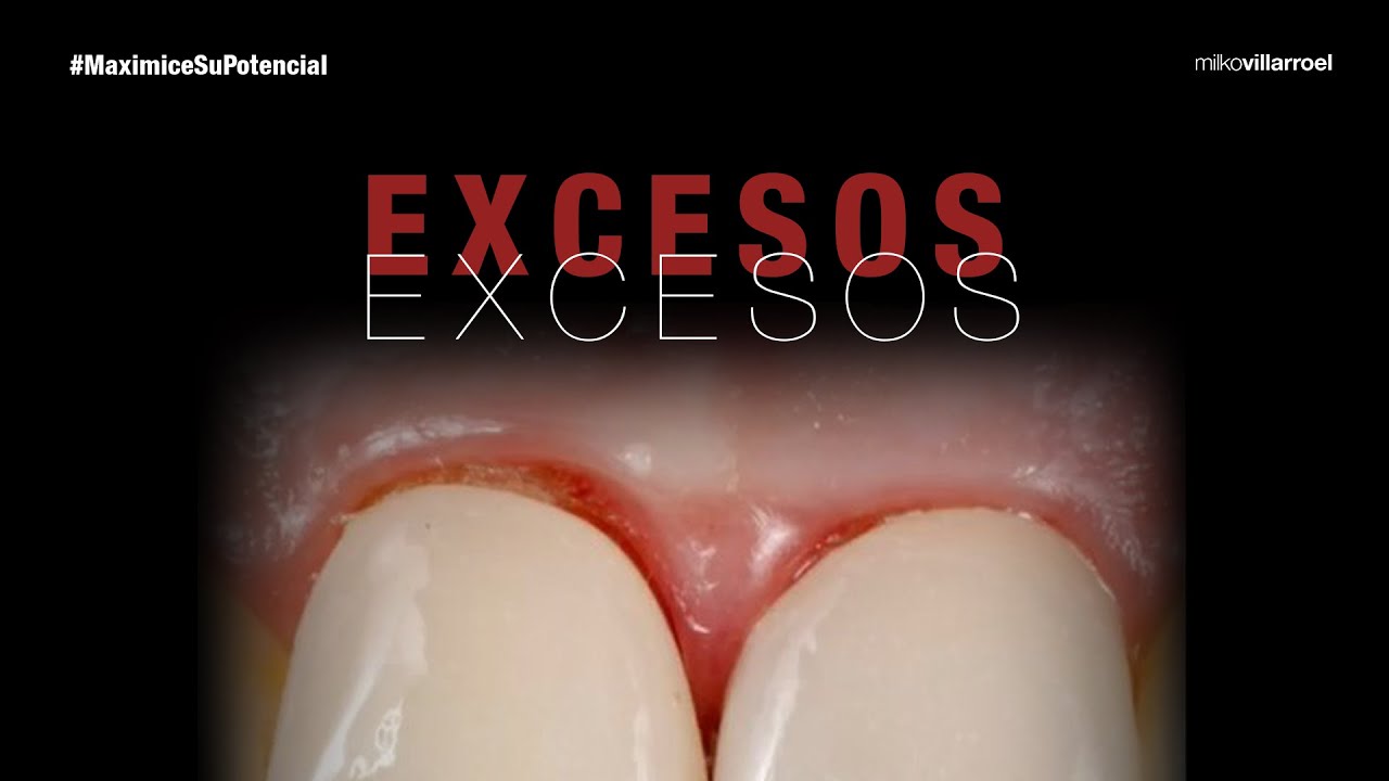 Correcta remoción de excesos – etapa fundamental  | #MaximiceSuPotencial | Milko Villarroel
