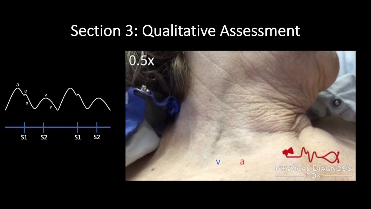 Jugular Venous Pulse: Qualitative Assessment
