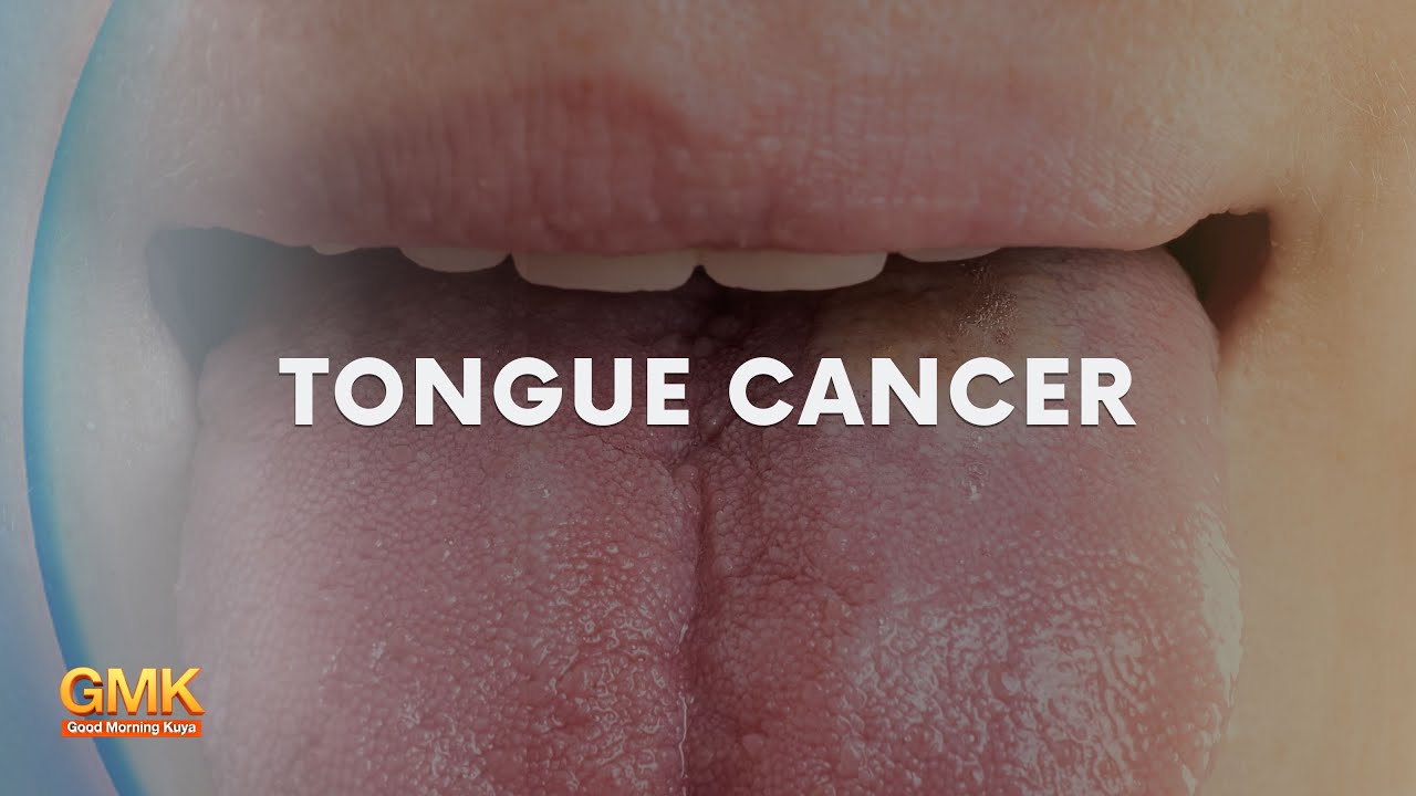 Tongue Cancer (Part 1) | Usapang Pangkalusugan