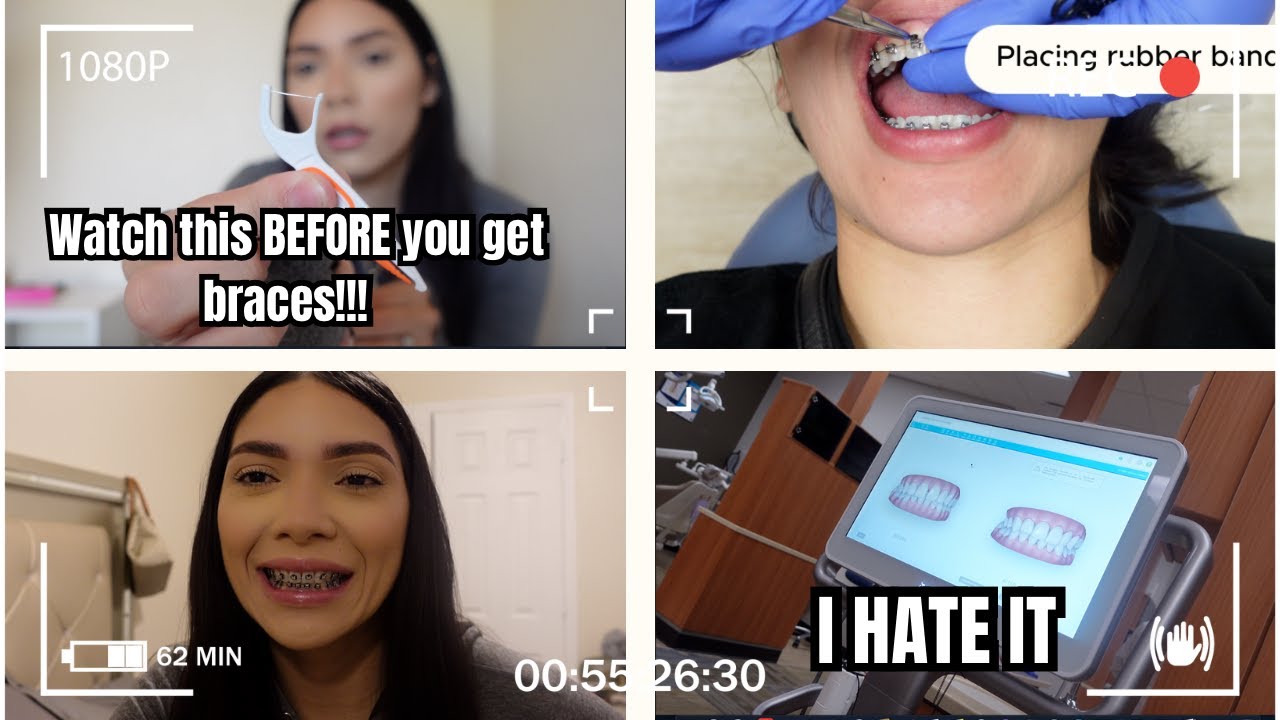 Braces Vlog: The Unfiltered Truth Behind My 3rd Journey😩