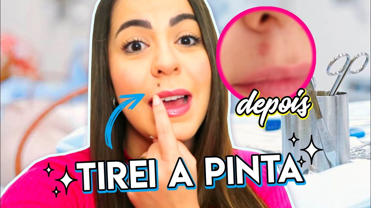 REMOÇÃO DE PINTA - REMOVI A PINTA DA BOCA COM CIRURGIA  | Carol Ramos