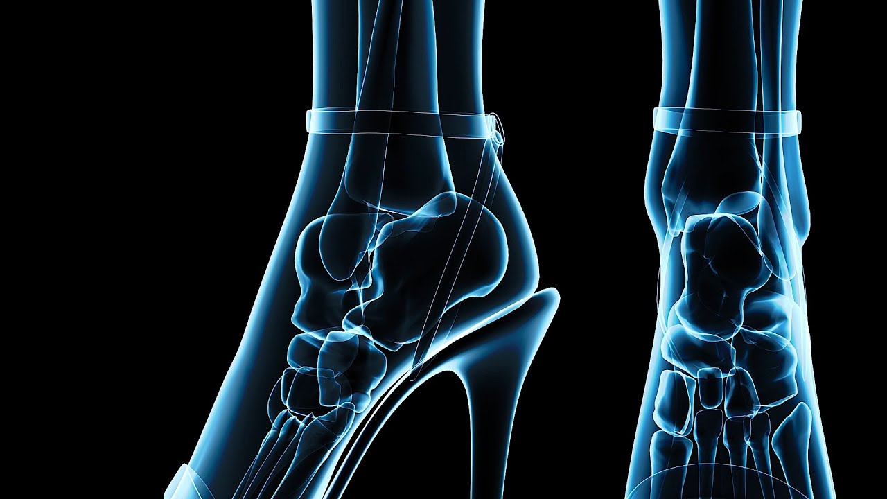 How to Recognize Haglund's Deformity | Foot Care