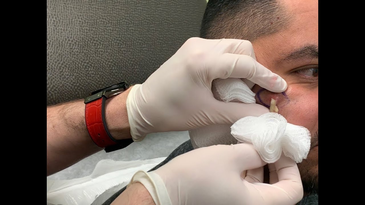 Complete Cyst I&D Video from Las Vegas Dermatology