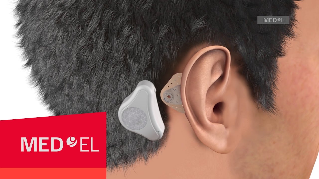 So funktioniert ADHEAR - das Knochenleitungsh&ouml;rsystem von MED-EL