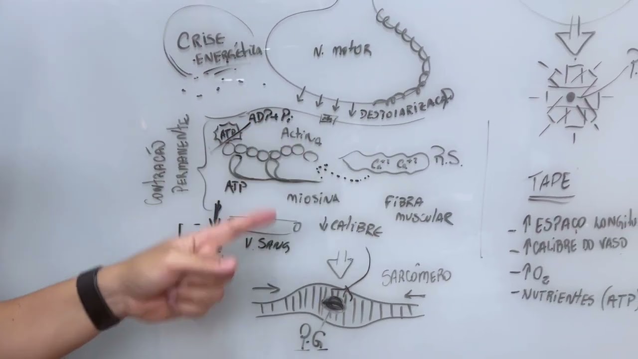 Aula 21 - Como desativar Pontos Gatilho com a bandagem elástica funcional