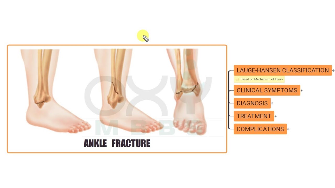 ORTHOPAEDICS - Ankle fracture- 1