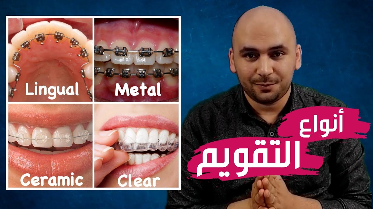 تقويم الأسنان وأنواعه التقويم الشفاف والعادي وأسعار تقويم الأسنان المختلفة